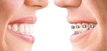 Clínica Dental Pisonero Blanco ortodoncia 1