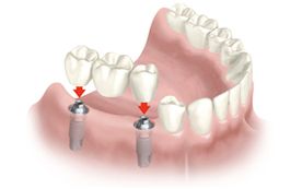 Clínica Dental Pisonero Blanco implantes 2