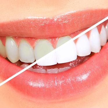 Clínica Dental Pisonero Blanco blanqueamiento dental 2