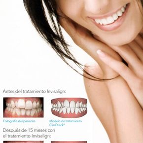 Clínica Dental Pisonero Blanco tratamientos de invisalign 2