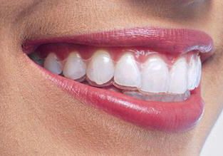 Clínica Dental Pisonero Blanco tratamientos 3