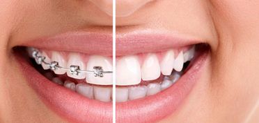 Clínica Dental Pisonero Blanco ortodoncia 2