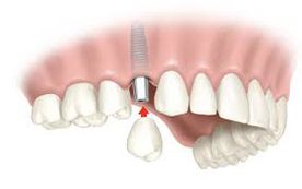 Clínica Dental Pisonero Blanco implantes 1